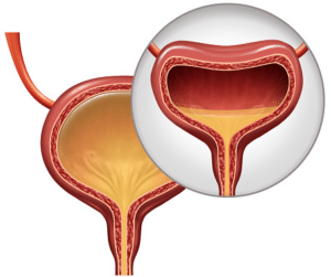 Overactive bladder treatment