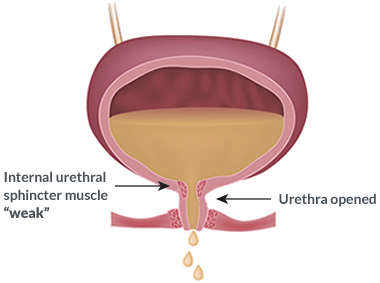 illustration of bladder and urethra leaking urine demonstrating urinary incontinence