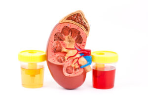 Normal,Urine,,Hematuria,,Kidney